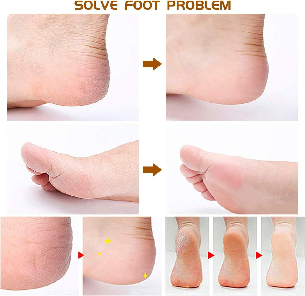 Foot File Callus Remover